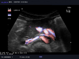 Ultrazvok ledvic - barvni dopler desne ledvične arterije (normalen izvid)